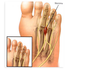 Neuroma-de-Morton