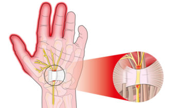 tunnel carpale